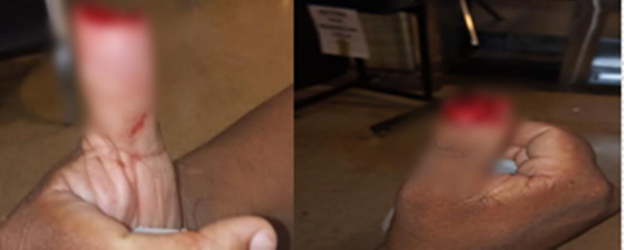 Mulher morde e arranca parte do dedo polegar de policial militar de Aparecida