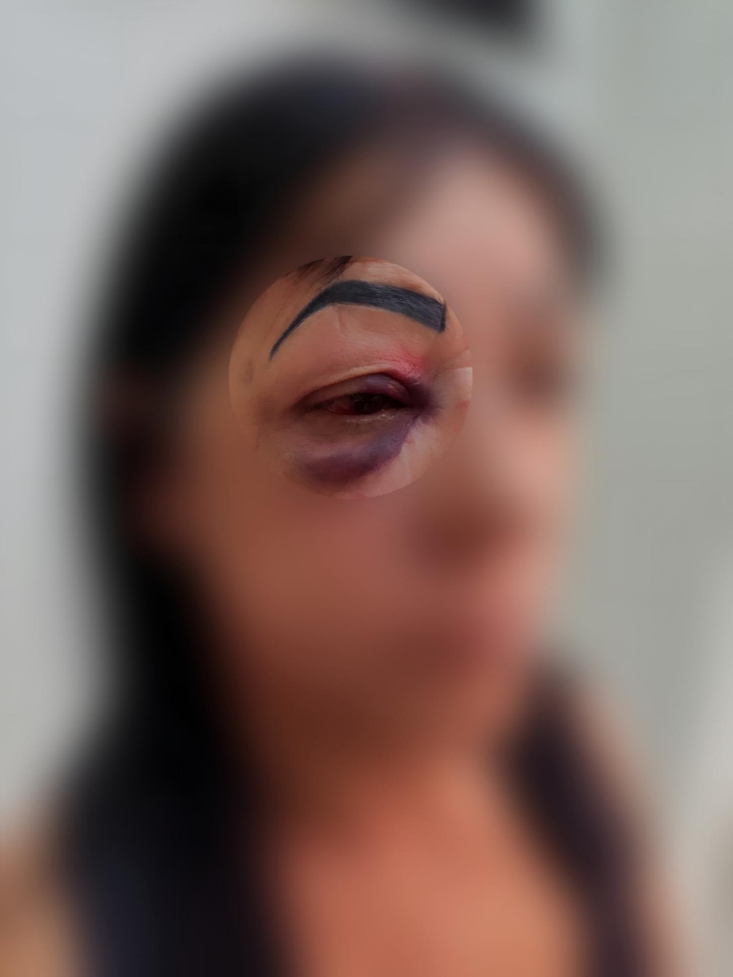 No Dia Internacional, mulher é agredida com soco no olho